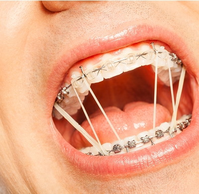 how fast do rubber bands move teeth